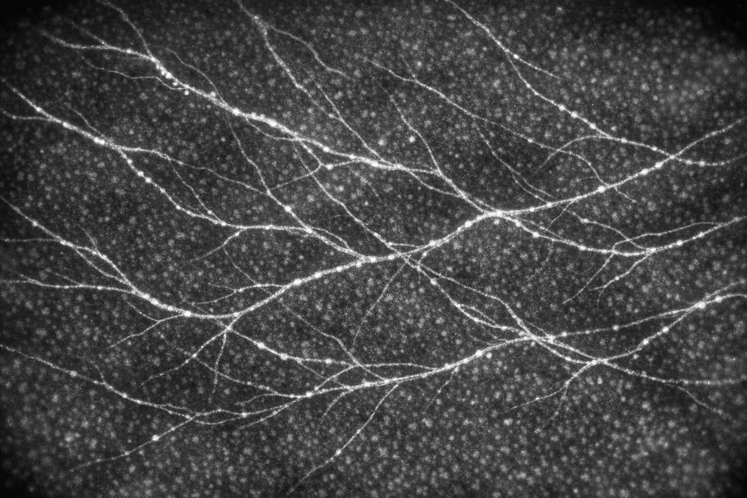 ARA-290 (cibinetide): a fragment of erythropoietin that acts on nerves, not on blood